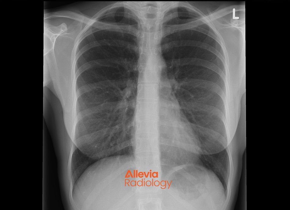 Allevia Radiology Chest X ray supplied