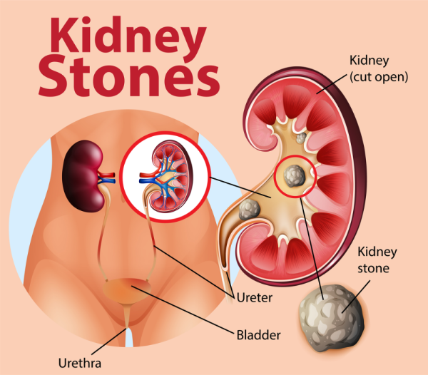 Diagram showing placement of kidneys, cross-section of kidney and a stone