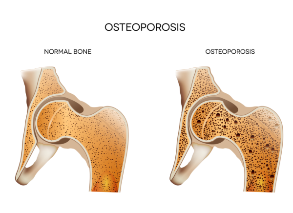 Normal bone and bone with osteoporosis