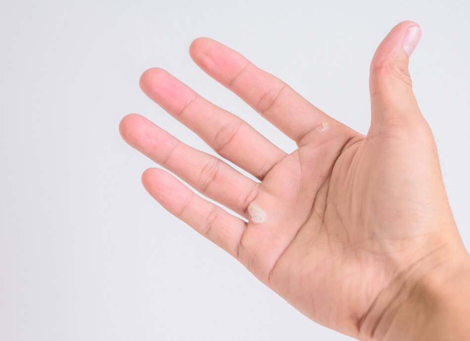 Blister on palm of hand canva 