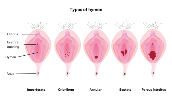 Different types of hymen